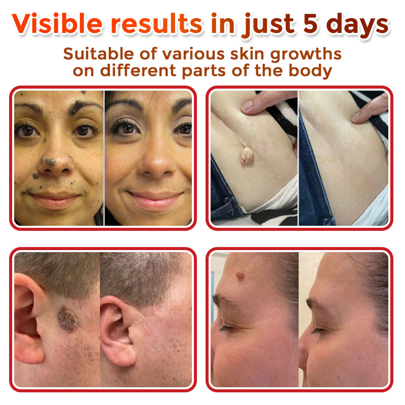 LushSter™ – Say Goodbye to Skin Tags.