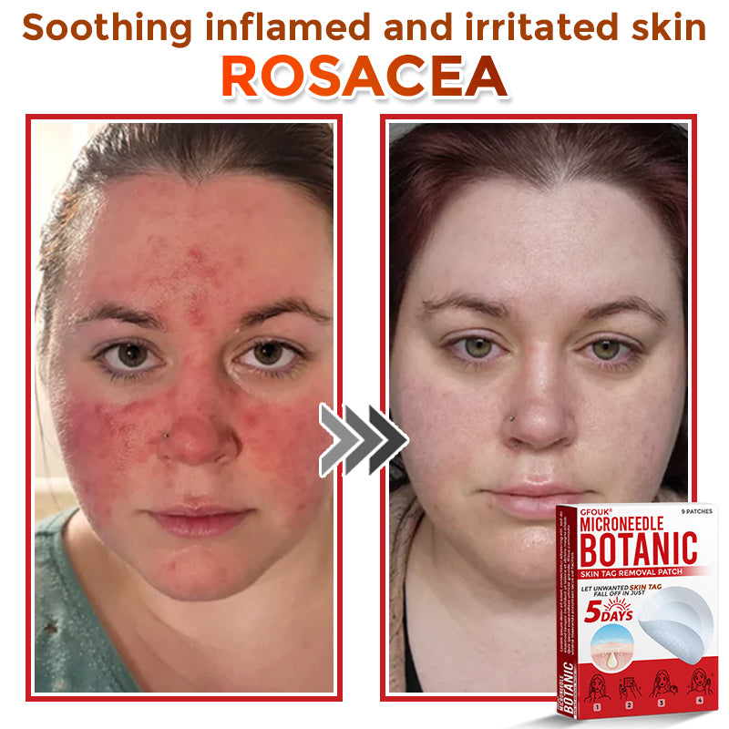 LushSter™ – Say Goodbye to Skin Tags.